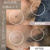 シミケア高濃度ハーブピーリング🌿