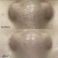 3.4月特別価格🌟ハイドラ毛穴洗浄+顔脱毛¥13,500→¥6,600