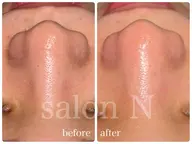 毛穴洗浄🫧¥6,600→¥3,300✨スキンケアでは取り切れない汚れをスッキリ綺麗に♪(鼻のみ)