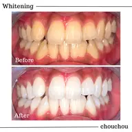 【初回限定】高濃度医療ジェルホワイトニング