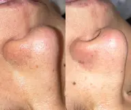 【毛穴詰まり/黒ずみ/開き】韓国式ハイドラ毛穴洗浄＋高保湿パック導入