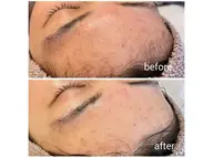 【メンズ限定】ハーブピーリングヘッドマッサージ付き《ハーブ1g(¥5500分)プレゼント》