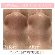 【本日13日1名様限定】即日実感✨全顔ハイドラフェイシャル毛穴洗浄×美容液で毛穴レス肌へ【黒ずみ・詰まり毛穴に】