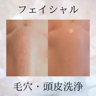 業界最新機器!【毛穴の黒ずみ/詰まり解消】頭皮洗浄付き🧚60分 ¥5,500