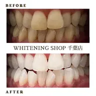 【念入りケア✨】１５分×３回照射💎