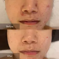 今の肌に足りないものを土台作り!オーダーメイド【トロイアルケ韓国肌管理】LDM+LED込