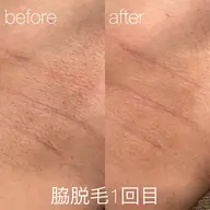 【メンズ♂】全身脱毛