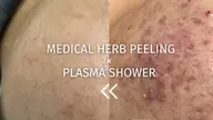 【本気のニキビケア】メディカルハーブピーリング×韓国プラズマシャワー⚡️