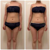 結果重視の痩身！ハイパーナイフ全身60分