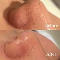 【モデル価格10名限定】🫧全顔毛穴洗浄🫧|水光肌ケア|ハイドラフェイシャル　⚠️動画撮影・口コミ可能な方のみ