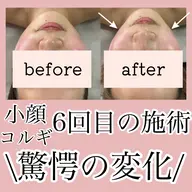 顔コルギ＋カッサ💆 【顔のむくみ】【たるみ】【ほうれい線】などのお悩みに✨超絶小顔‼️