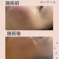 ニキビ　敏感肌の悩みの方　有機玄米の酵素パックで肌質改善