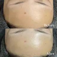 🌹【シワケア・かゆいニキビ・塗るボトックスで】REVIハーブピーリング《陶肌トリートメント》 /➕PRB 0.8ml