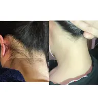 ♪うなじ脱毛￥4,400✨️人気！♪ヽ(´▽｀)/