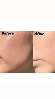 マスク顔周り毛穴プツプツ＋トラブル肌◎冷んやりピールオフパック＋イオン導入＋ハチミツパック&ヘッドスパ付き