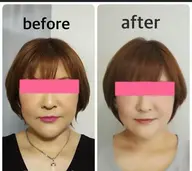 痛くない小顔矯正➕超脳クレンズ　ヘッドマッサージ