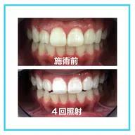 ✨ご新規様minimo限定✨歯のセルフホワイトニング８分×4回照射　(施術時間60分)