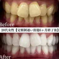 セルフホワイトニング⭐︎人気No.1 ⭐︎定額制通い放題10,800円/1ヶ月（6ヶ月継続必須）