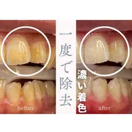 医療ホワイトニング4回照射
