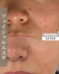 初回限定＊肌質改善フェイシャル