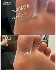 【ミニモ限定】魚の目除去　1個 （爪ケア込み）