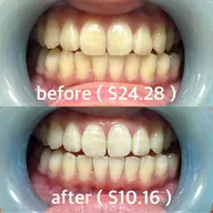 クリスマスまでに間に合う☀️徹底美白ホワイトニング4回セット