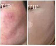 【肌荒れ・ニキビ・ニキビ跡】ソフトハーブ&イオン導入【トーンアップ】