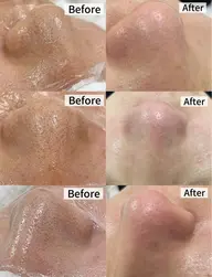 人気No.1【毛穴レス&もちもち理想肌】毛穴洗浄✕潤いフルケア60分