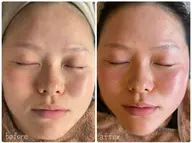 フェイシャルWAX脱毛