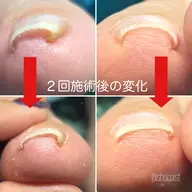 【３回コース】巻き爪ケア【メンズOK◎】