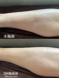 メンズ両足全体脱毛