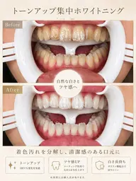 💎ずっと都度払い💎セルフホワイトニング🦷12分×2照射✨漂白成分配合✨