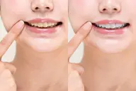 ⭐︎4月限定⭐︎1回で分かるホワイトニングモニター♪2回分💘