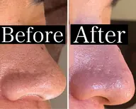 黒ずみ毛穴撃退💥【ハイドロ毛穴洗浄】ブラックヘッド/角栓/ニキビ/ニキビ跡