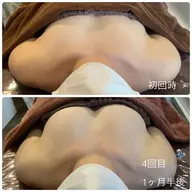 【お時間限定】プレミアム育乳コース☆本気でボリュームアップしたい方☆ハンドマッサージ×生体電流×光豊胸×美容液導入