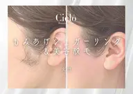 【女性W脱毛】シュガーリング＆美容脱毛　もみあげ/3300円