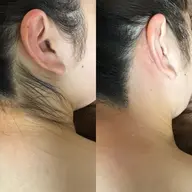 【ブライダル向け】プレ花🆗🌼お背中うなじ肩全部お任せセット🎶シェービング＆ワックス付き光脱毛👰‍♀️¥9,800