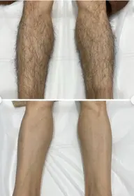 メンズ脱毛　足全体脱毛