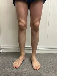 男性足まるごと脱毛メンズ