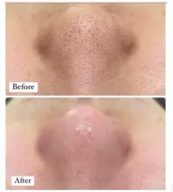 毛穴エクストラクション×クリスティーナ肌質別栄養マスク+ヘッドマッサージ付　¥11500→