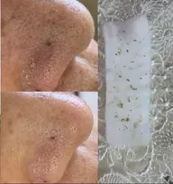 【鼻の毛穴洗浄】毛穴ハンド技術/毛穴汚れ/毛穴角栓取り(鼻のみ)