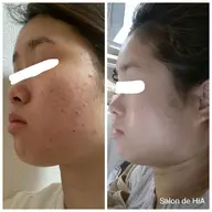 ✨新登場✨60分🕑️肌質改善🌿日本製ハーブピーリング🌿剥離なし◎ダウンタイムなし◎痛みなし◎即メイクOK◎