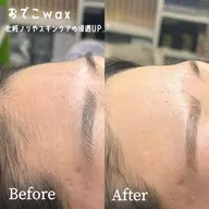 【💎おでこの産毛除去💎】おでこwax🪿ワックスしてうぶ毛スッキリ✨トーンアップ効果抜群🪄🪽