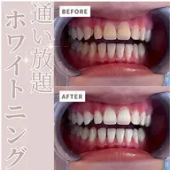 【人気No.1】強力 セルフホワイトニング(9分×2セット)1回￥980