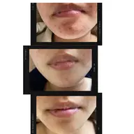 毛穴、ニキビケアフェイシャル(1回)