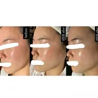 ツヤ肌仕上げ◎水光ピーリング《肌荒れ・毛穴が気になる方に》