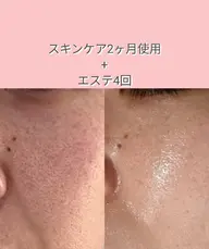 【カウンセリング.お土産付き🎁】お肌の相談だけでも大歓迎 ܀ꕤ୭*ご予約、ご来店お待ちしてます。