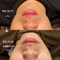 【メンズ人気No.1メニュー】ヒゲ脱毛（顔全体）体験