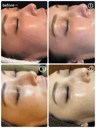 【水光艶肌】REVI  NMNハーブピーリング