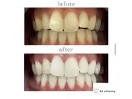 セルフホワイトニング🦷✨【30分照射】ミニモ限定価格